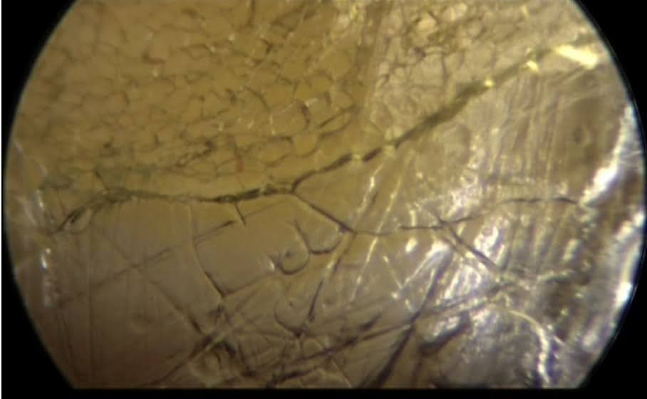 Photo de fascia sous endoscopie