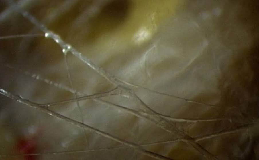 Photo de fascia sous endoscopie