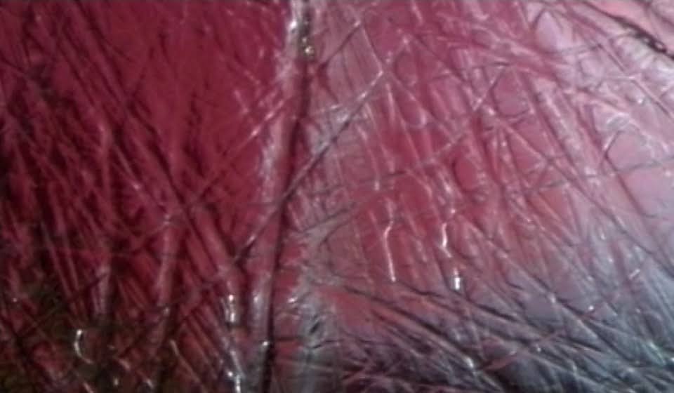 Photo de fascia sous endoscopie