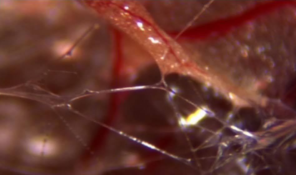 Photo de fascia sous endoscopie
